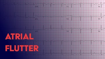 Atrial Flutter -  EKG (ECG) Interpretation