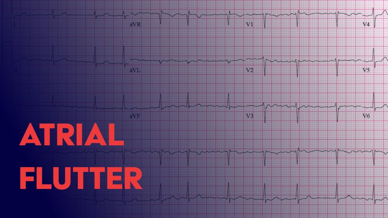 Atrial Flutter Litfl Ecg Library Diagnosis