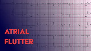 Atrial Flutter -  EKG (ECG) Interpretation