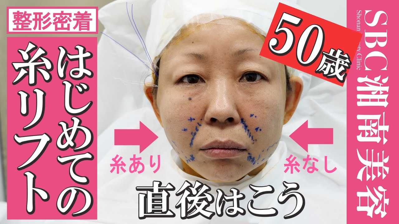 【50歳糸リフト密着】初整形アラフィフのタルミ上げ♥糸選びからオペ直後までを追ったら上がってた【タルミ・ほうれい線・フェイスラインを引き上げて小顔】＠湘南美容クリニック