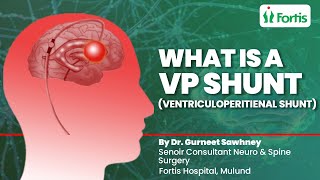 Ventriculoperitoneal Shunt | What Is A VP Shunt Used For | Is VP Shunt A High Risk Surgery | MUL
