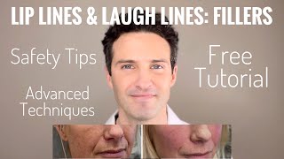 Fillers : Upper Lip lines, Smile lines & Accordion lines (part 2 of 3 series)