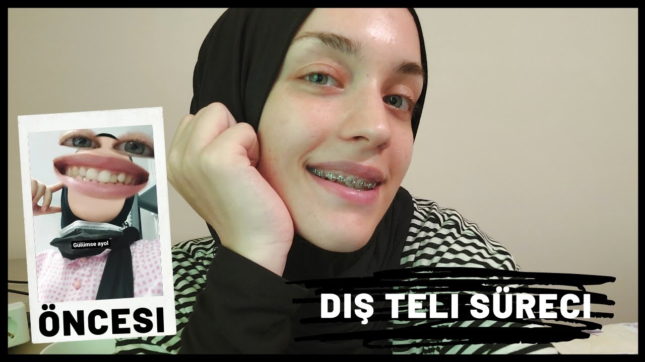 DİŞ TELİ TEDAVİ SÜRECİ | Ağrı, fiyat, temizlik