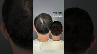 #광주두피문신 #목포두피문신 #전주두피문신 #순천두피문신 #두피문신비용 #두피문신부작용 #디블랙 #디블랙광주 010 9106 7506 #디블랙목포 010 6228 2333