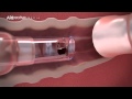 Arcreative media  early works showreel medical device 3d animation