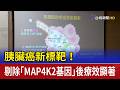 胰臟癌新標靶！ 剔除「MAP4K2基因」後療效顯著