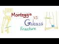 Monteggia Vs. Galeazzi fracture