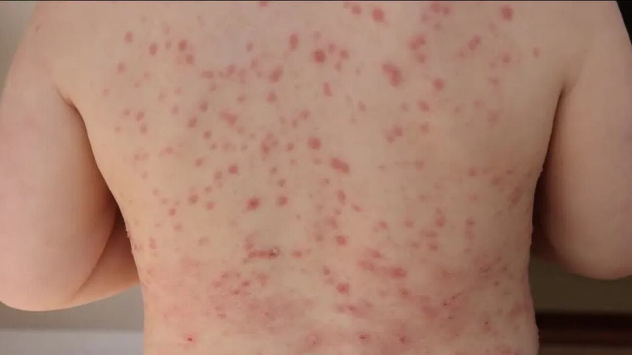 Measles case connected to Springfield-Branson National Airport