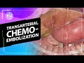 Treating liver cancer through a tiny incision (3D Animation)