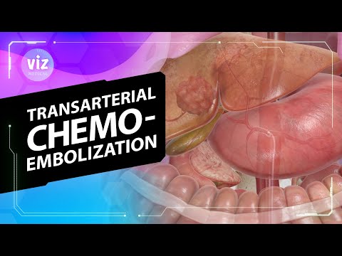 Treating liver cancer through a tiny incision (3D Animation) - video from ViewMedica