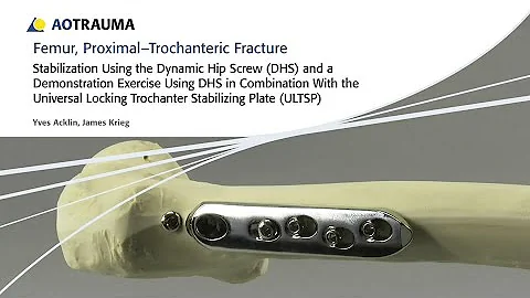 Femur, Proximal – Trochanteric Fractures – Stabilization Using the Dynamic Hip Screw DHS with ULTSP