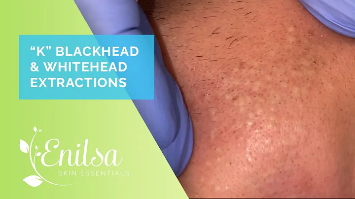 Blackhead & Whitehead Extractions on "K" - April 2...