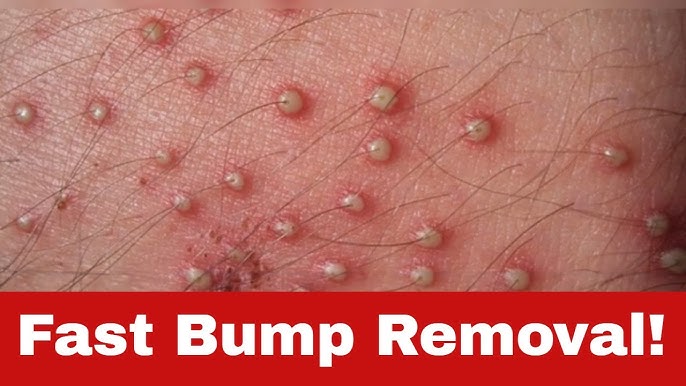 5 Ways To Must-know Tips For Treating Hair Bumps In 2024