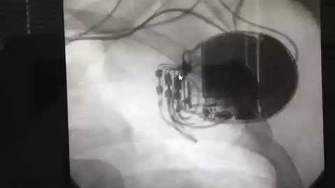 Video 53.1 - Interventional Cardiac Electrophlysiology