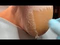 Superb technique： Clean all the build up under soles of feet