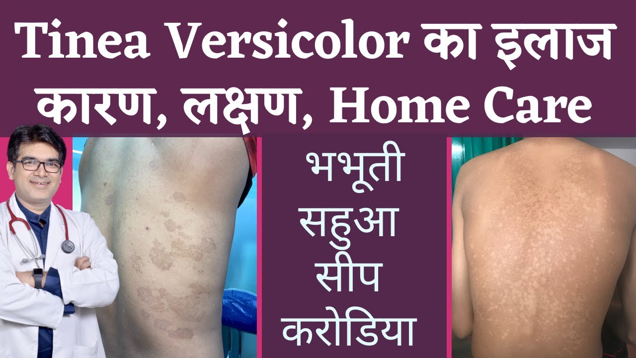 Tinea Versicolar Treatment | भभूती/सीप/सहुआ/करोडिया का इलाज