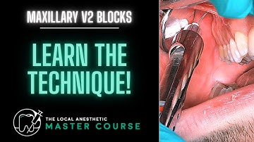 How To Do A Maxillary Nerve Block | Local-Anesthetic.com