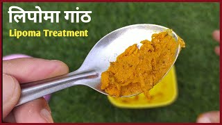 शरीर की कैसी भी गांठ एक बार रात में लगाकर सो जाओ जड़ से खत्म//Lipoma Ganth Ka ilaj