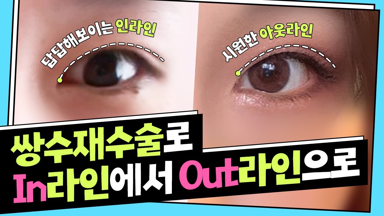 [쌍수] 쌍수 재수술, 인라인에서 아웃라인되는방법!