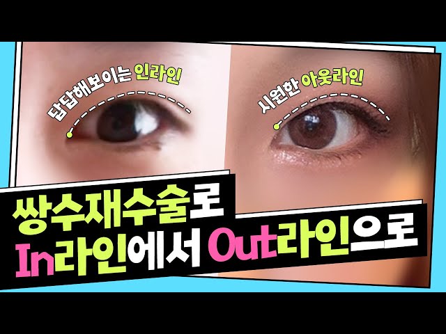 [쌍수] 쌍수 재수술, 인라인에서 아웃라인되는방법!