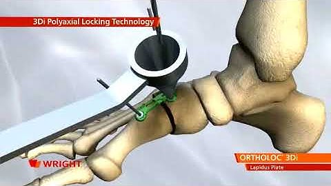 ORTHOLOC 3Di LAPIDUS SYSTEM