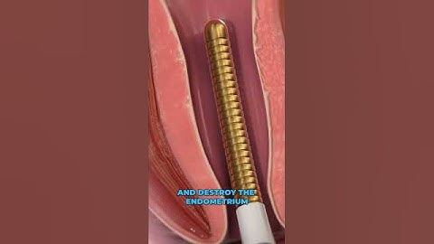Using cold to stop menstrual bleeding (3D Animation)