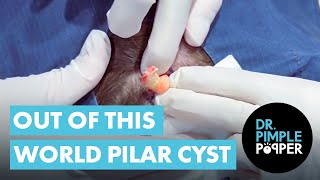 OUT OF THIS WORLD PILAR CYSTS