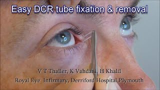 Easy Silicone Sleeve DCR Stent Fixation