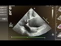 Dilatation of ascending aorta &amp; aortic arch