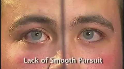 HGN Test | Horizontal gaze nystagmus | HGN | Nystagmus Test | Horizontal gaze nystagmus test