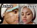 SHAVING MY FACE FOR INSTANT CLEAR SKIN| Dermaplanning @ Home | Igbo Girl Shaves Her Face.