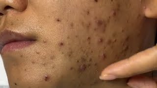 Satisfying Asmr Facial Routine For Acne-Free Skin & Blackhead Removal