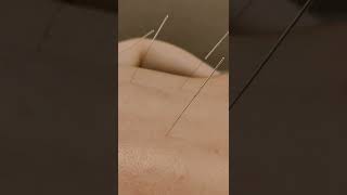 Dry Needling