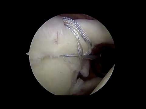 Single portal percutaneous SLAP repair