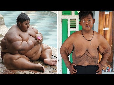 Vídeo: O Menino Mais Gordo Do Mundo Reduziu O Estômago E Perdeu 100 Kg - Visão Alternativa