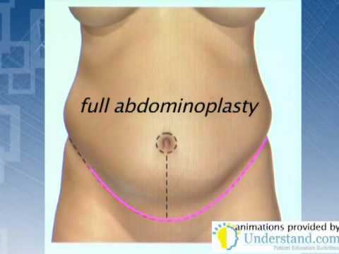 Abdominoplasty Houston