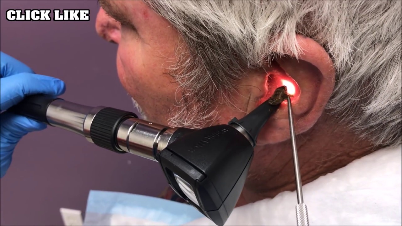 Biggest Ear Wax Removal Ever! YouTube