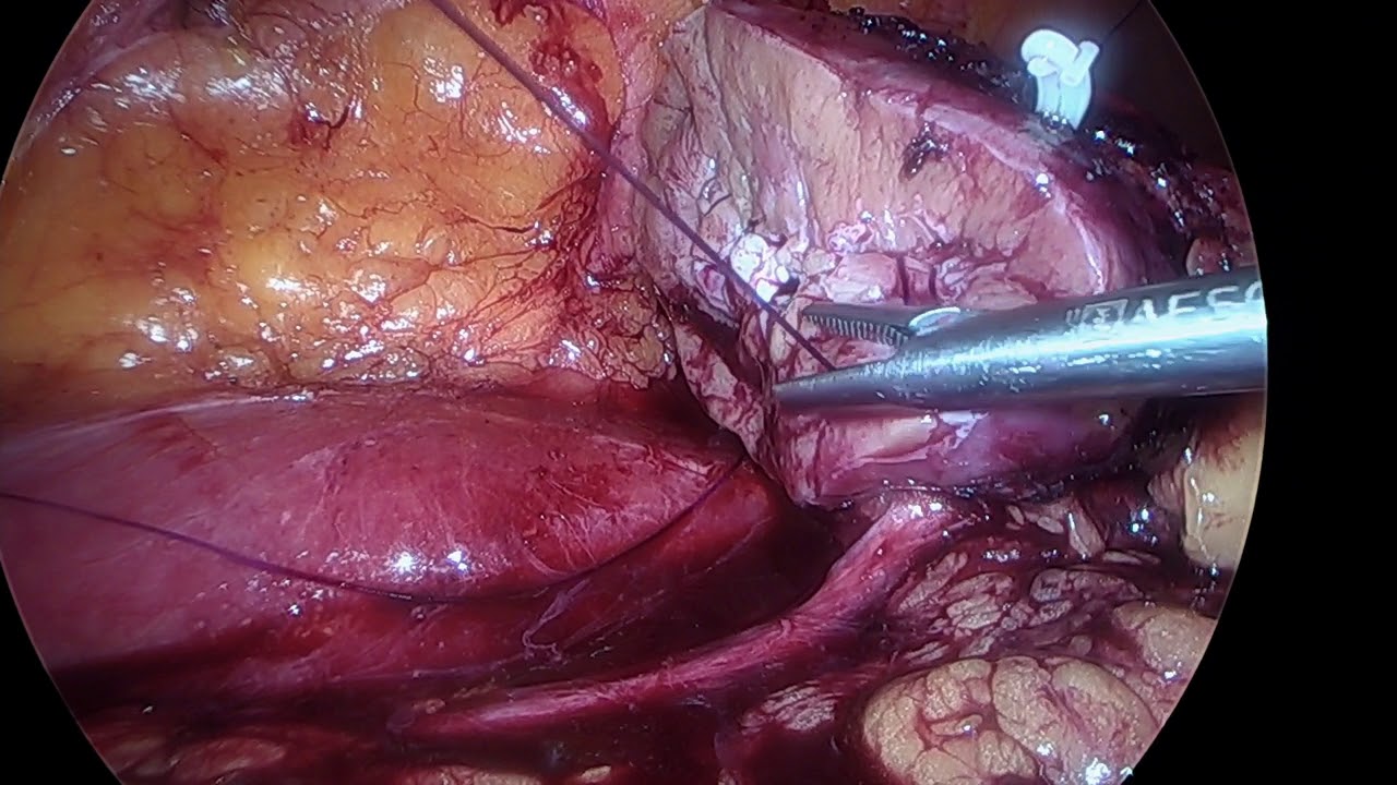 Laparoscopic Partial Nephrectomy - Technique 1