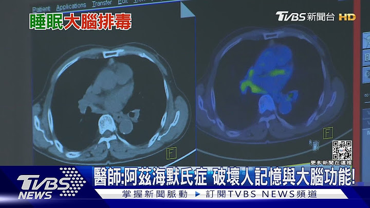 長期出現「這症狀」...未來罹患「阿茲海默氏症」風險增....｜十點不一樣20230314 @TVBSNEWS01 - 天天要聞