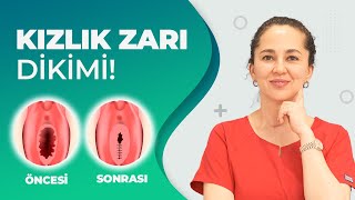 Kızlık Zarı Dikimi (Hymenoplasty) | Op.Dr. Ebru Ünal | 0 532 632 4034 Resimi