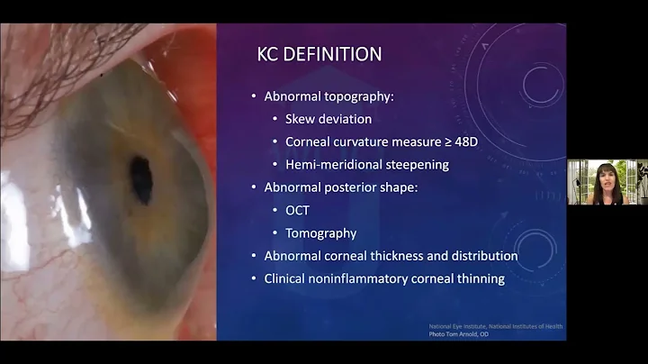 How to diagnose keratoconus without fancy equipment