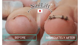 How to apply NailLift for Practitioners