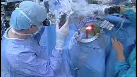 Podcast: Temporal Lobectomy Epilepsy Surgery