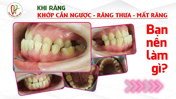 Quá Trình Niềng Răng Khớp Cắn Ngược - Răng Khấp Khểnh