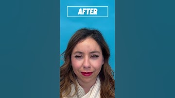 Before and After Botox! 💉 #botox #beauty #injectables