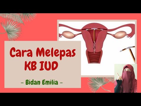 Video: Cara Melepas IUD: 9 Langkah (dengan Gambar)