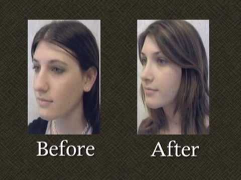 www.faceliftusa.com Washington DC plastic surgeon Dr. Mark Richards shares the results of a second rhinoplasty surgery case from Ageless Impressions Plastic Surgery Institute in Maryland. Dr. Richards shows us how he was able to achieve a more attractive jaw line for this patient by strictly re-contouring her nose. To find out what your options are for rhinoplasty surgery, please contact Ageless Impressions Plastic Surgery Institute today to schedule your consultation. Mark E. Richards, MD 11300 Rockville Pike Suite 912 N. Bethesda, Maryland 20852 (301) 468-3669