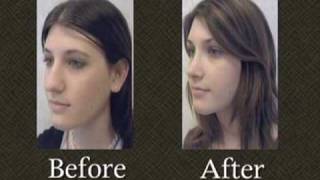 Rhinoplasty Nose Surgery Gallery Maryland  Dr. Mark Richards