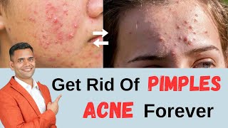 Get Rid Of Pimples,Acne Forever | How To Get Rid Of Acne and Pimples - Dr. Vivek Joshi