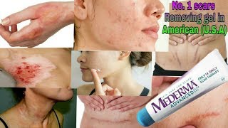 MEDERMA GEL || जले, कटे, ऑपरेशन और एक्सीडेंट के निशान को ख़त्म करने वाली दवाई।